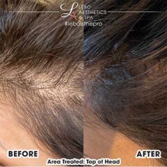 hair restoration before after