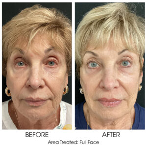 MICRONEEDLING with PDGF