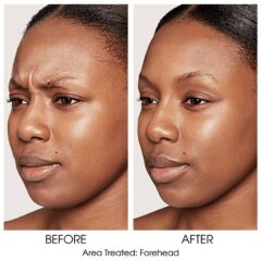 Dysport for Forehead
