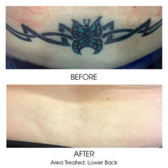 Tattoo Removal - Lower Back