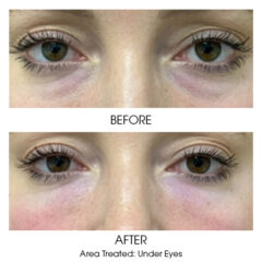Under Eye Rejuvenation Before and After 1