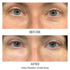 Under Eye Rejuvenation Before and After 2