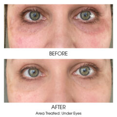 Under Eye Rejuvenation Before and After 3