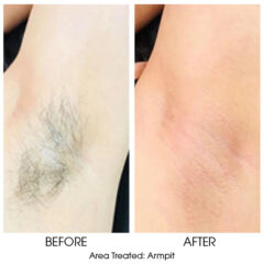 Before and After: Waxing Armpit