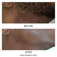 Before and After - Waxing Face
