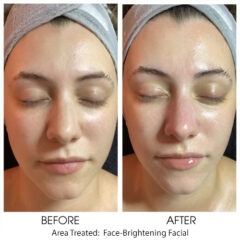 Brightening Facial1