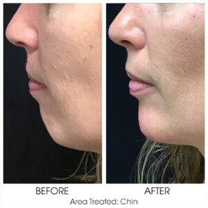 Filler for Chin