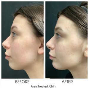 COSMETIC FILLER