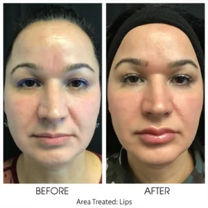 Filler for Lips