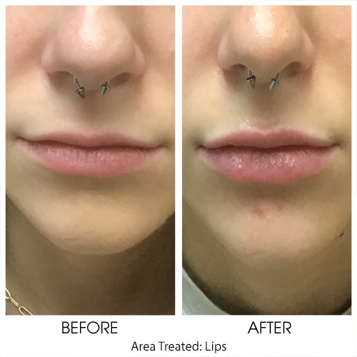 Before and after Cosmetic Filler treatment of lips