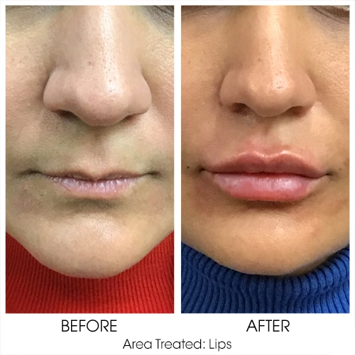 Lip Filler Before and After