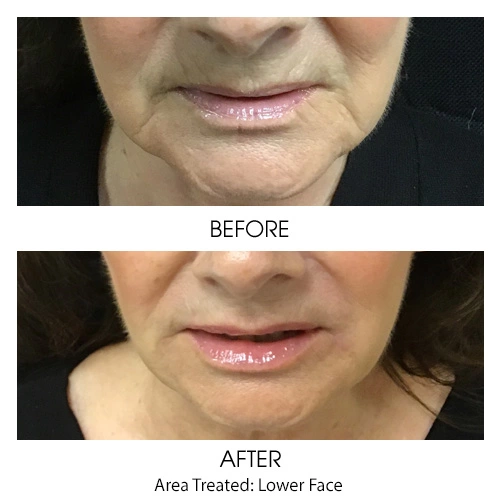 Cosmetic Filler for Mouth