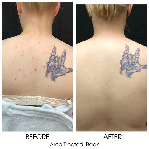 Chemical Peel for Back Acne