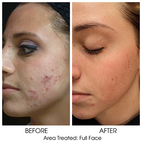 Chemical Peel for Acne Scars