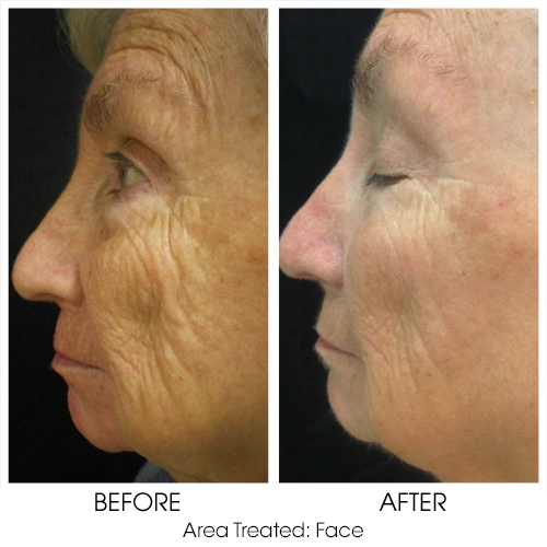 Chemical Peels for Wrinkles