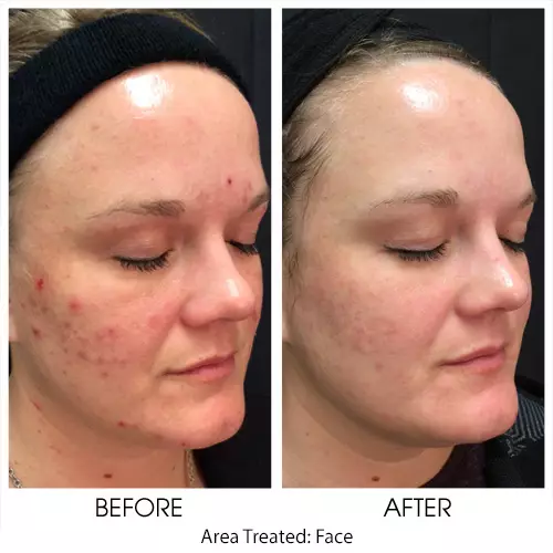Chemical Peel for Acne