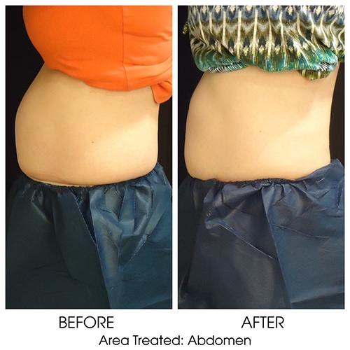 CoolSculpting®