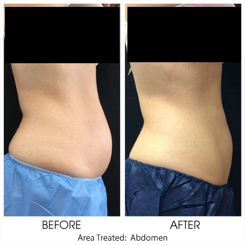 Coolsculpting for Abdomen