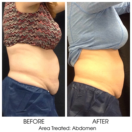 CoolSculpting®