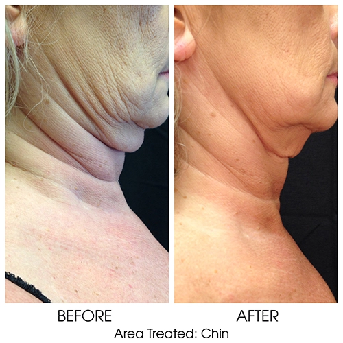 Coolsculpting for chin