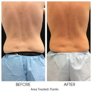 COOLSCULPTING