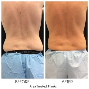COOLSCULPTING