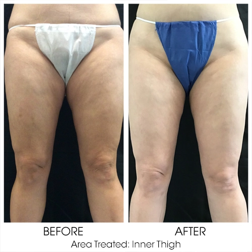 Coolsculpting for Thighs