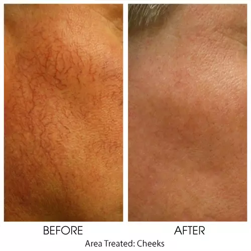 Photorejuvenation for cheeks