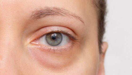 Dark Circles Under Eyes-compressed