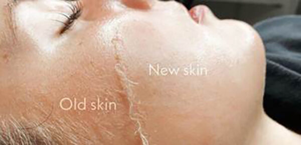 Dermaplaning_Example Dermaplaning_Example