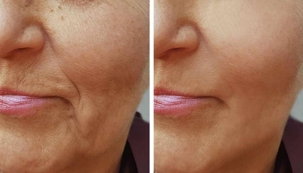 The Art of Facial Contouring: How Fillers Create Balance and Beauty