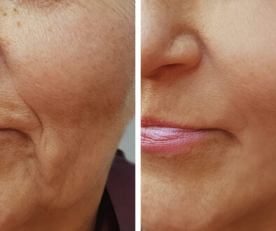 Facial Contouring