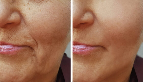 Facial Contouring