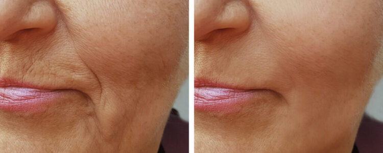The Art of Facial Contouring: How Fillers Create Balance and Beauty