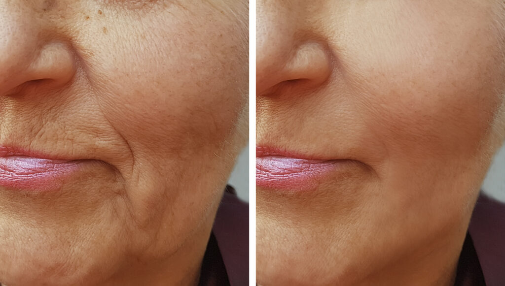 Facial Contouring