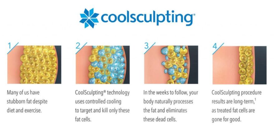 Coolsculpting Science