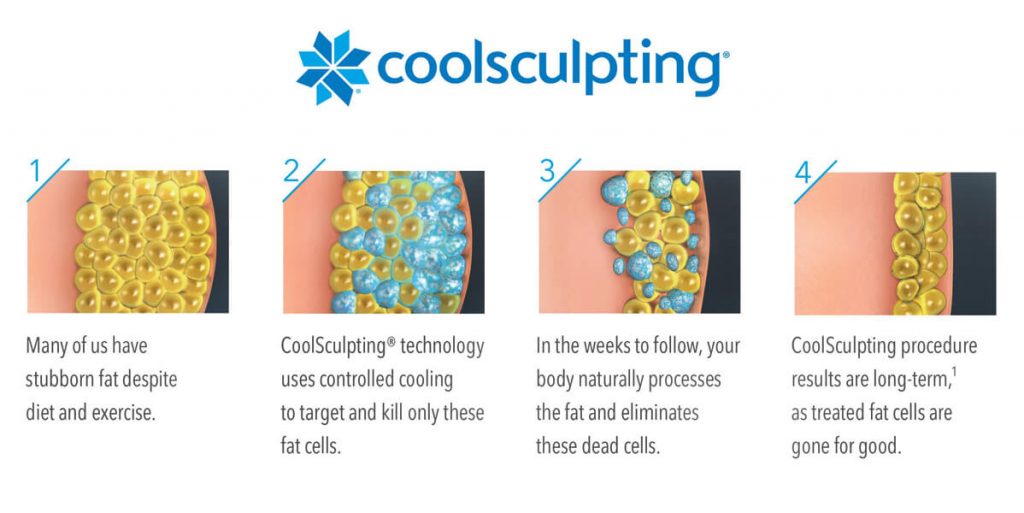 coolsculpting