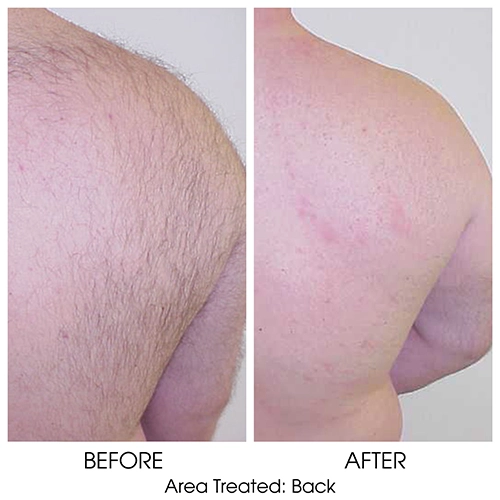 Laser Hair Removal for Back