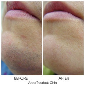 Laser Hair Removal for Chin