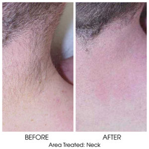 Laser hair removal for neck