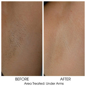Laser Hair Removal for Arm Pits