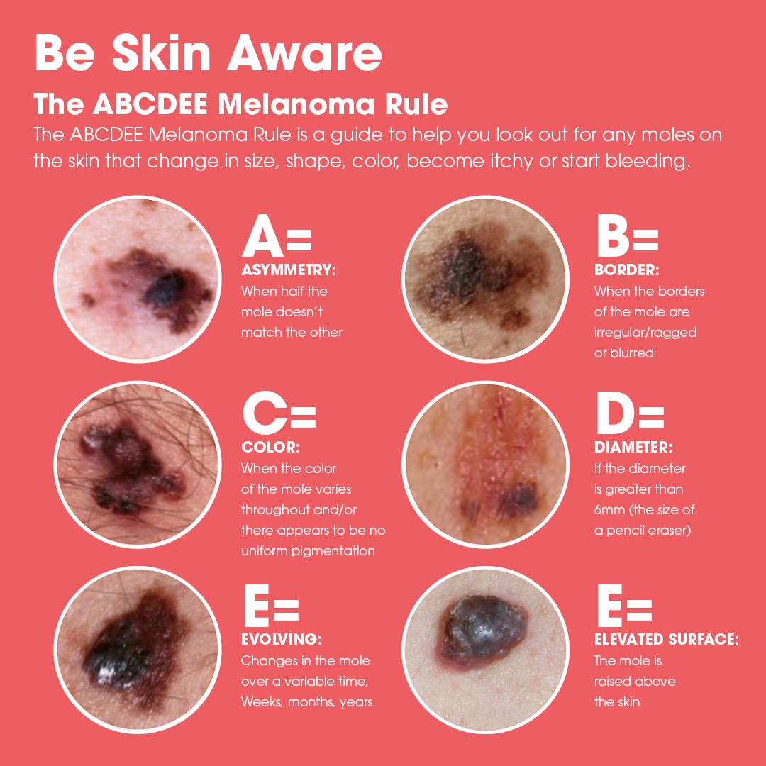 Melanoma Graphic square Skin Cancer Signs