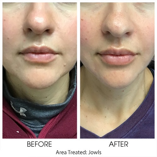 Before and After of PDO Threads treatment of jowls