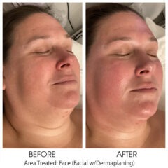 Prescription facial w Dermaplaning