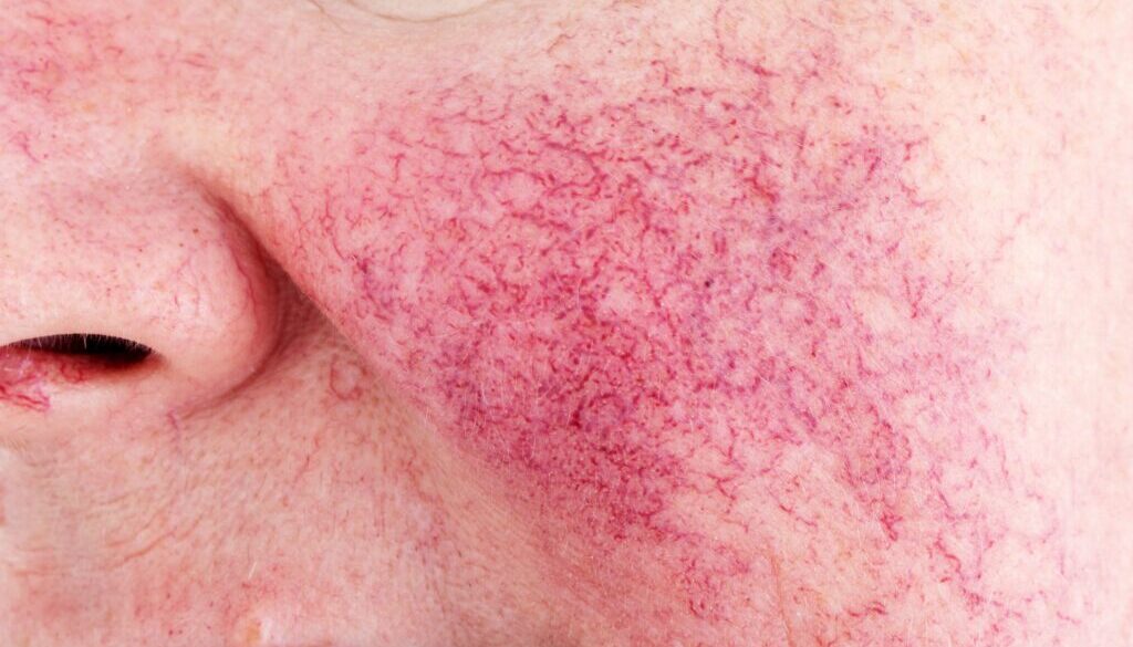 Rosacea