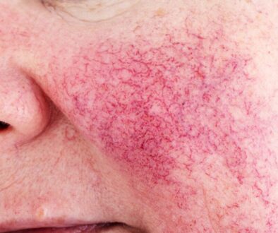 Rosacea