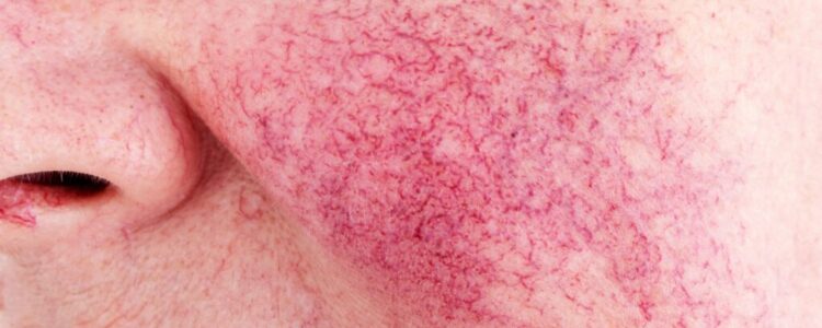 Rosacea Flare Ups In Summer? Here’s What You Need to Know