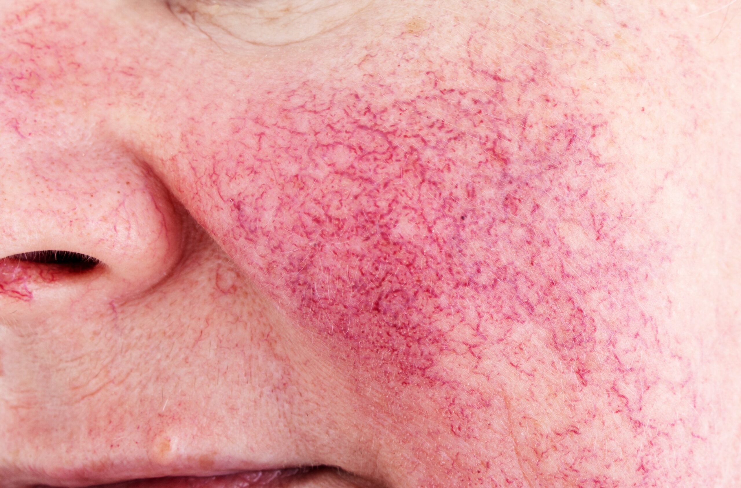 Rosacea