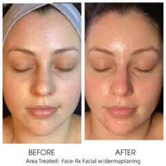 Rx Facial w dermaplaning