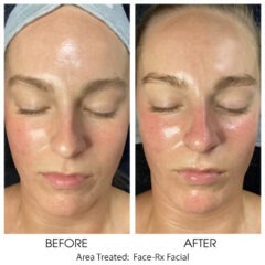 Rx Facial1